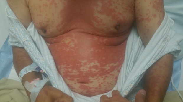 Drug eruption showing generalized rash